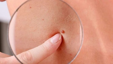 Skin Tags Removal Treatment